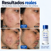 Loción Secante Para Acne