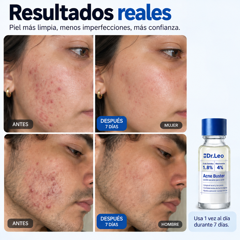 Loción Secante Para Acne