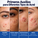 Loción Secante Para Acne